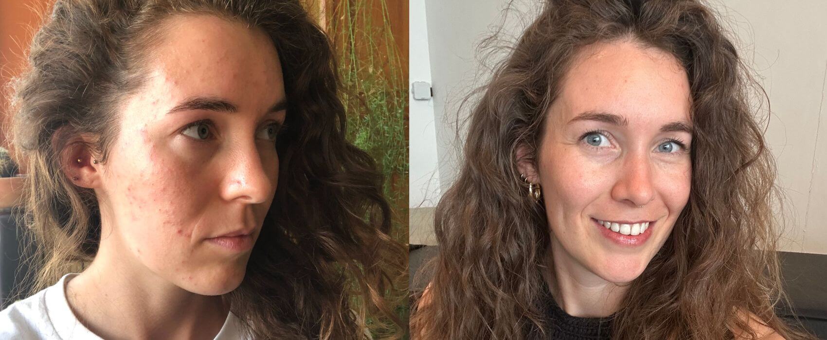 Voor & na - huid sil, acne