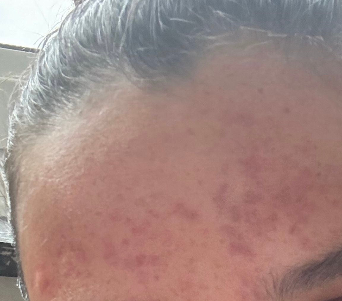 Voor&Na-Klant-Moisturizer-voor