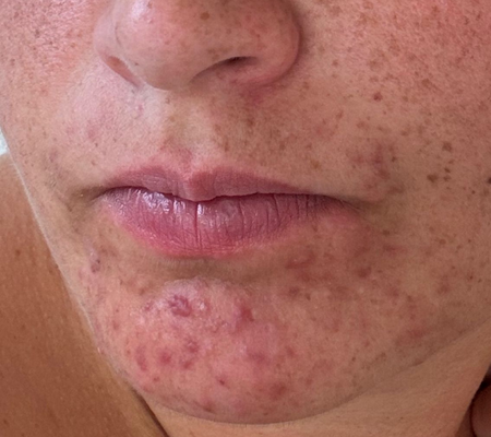 Voor&Na-Klant-Skin Savior Serum-voor