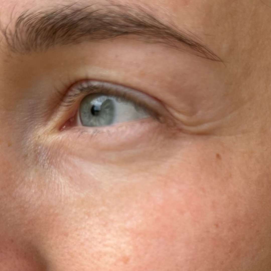 Voor_Na-Sil-Eye_Lip_Cream-Voor-Productpage