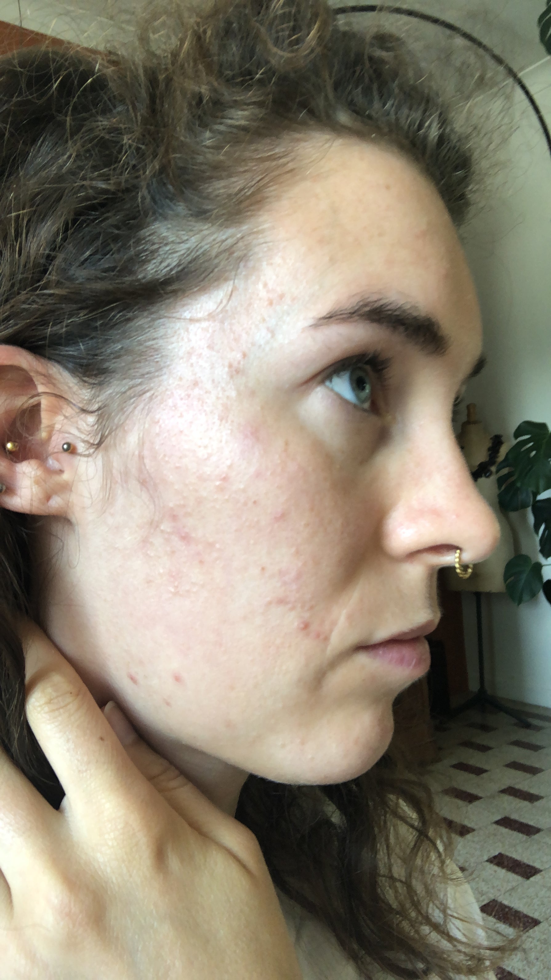 Voor/na-skincare-problems-pimples-Sil-Voor-2
