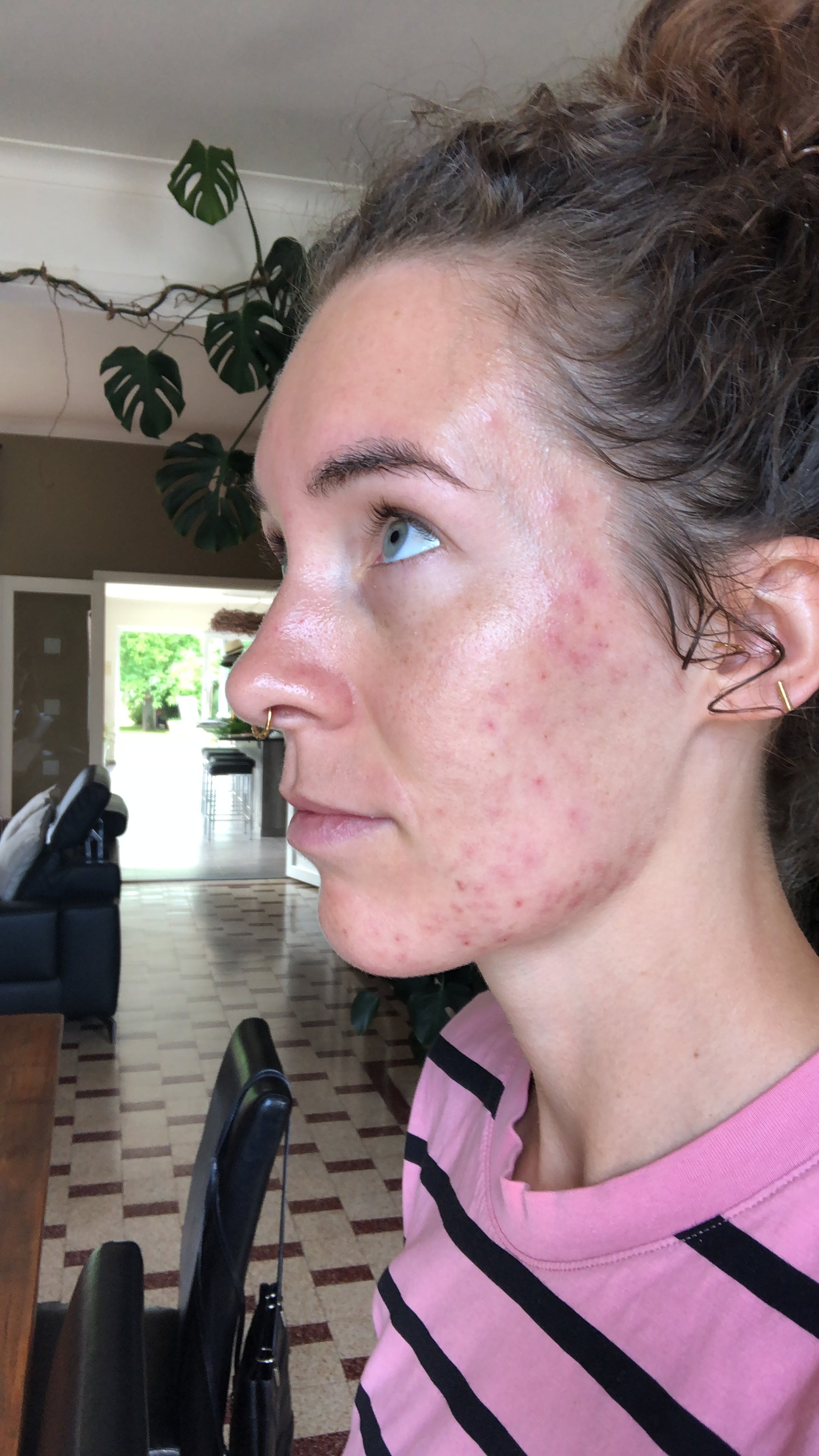Voor_na-skincare-problems-pimples-Sil-Voor-3