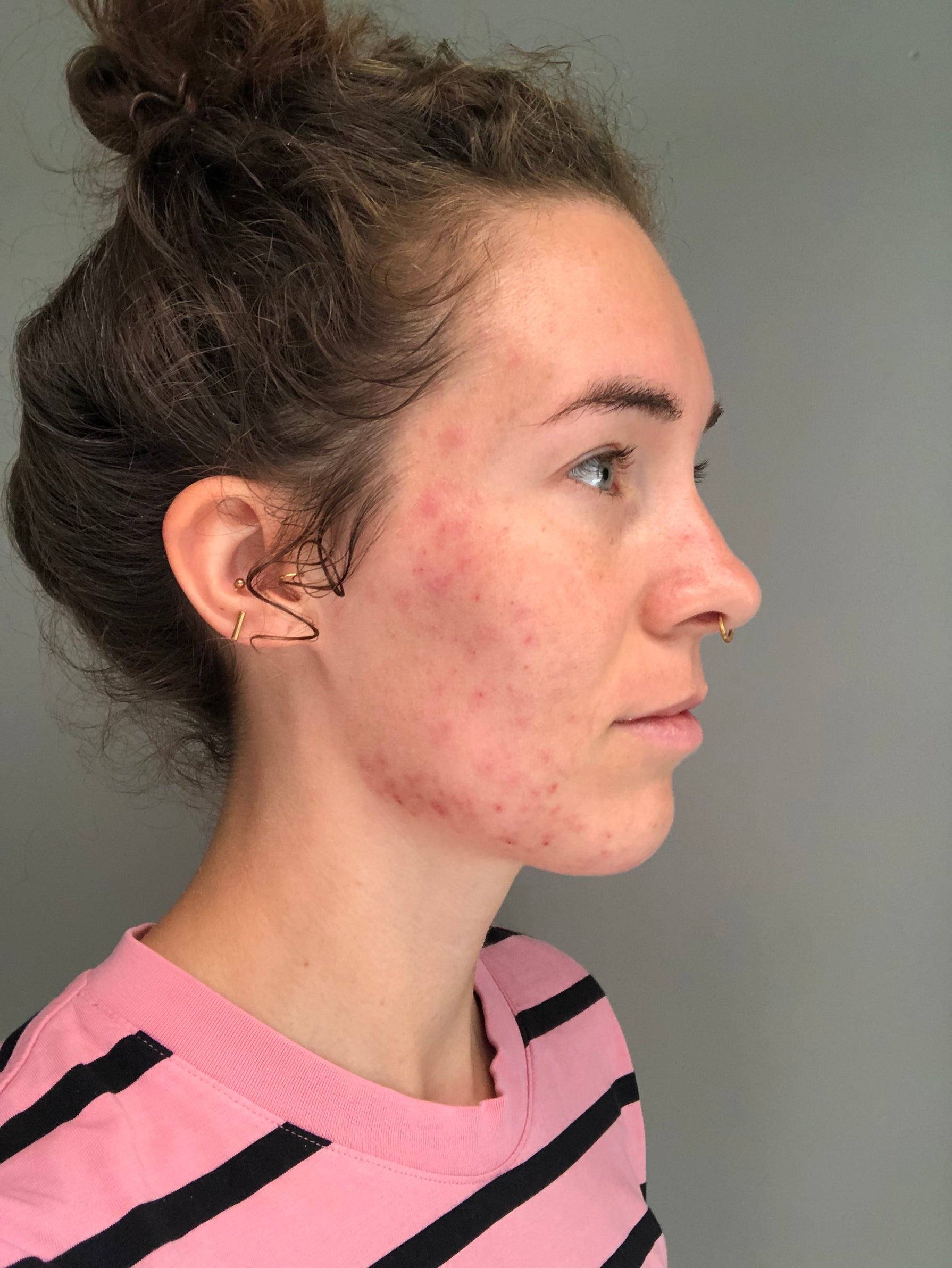 Voor_na-skincare-problems-pimples-Sil-Voor-5