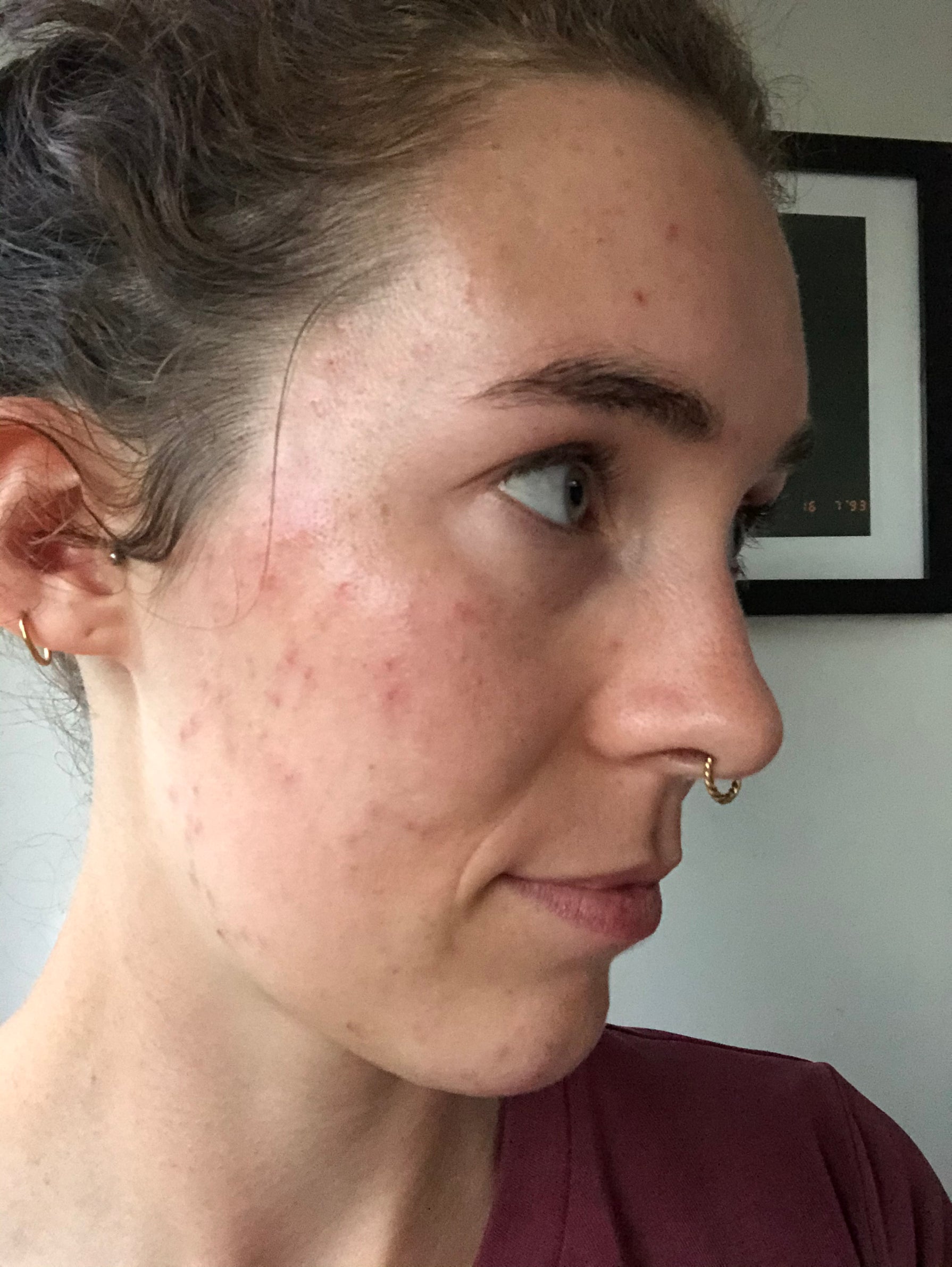Voor/na-skincare-problems-pimples-Sil-Voor