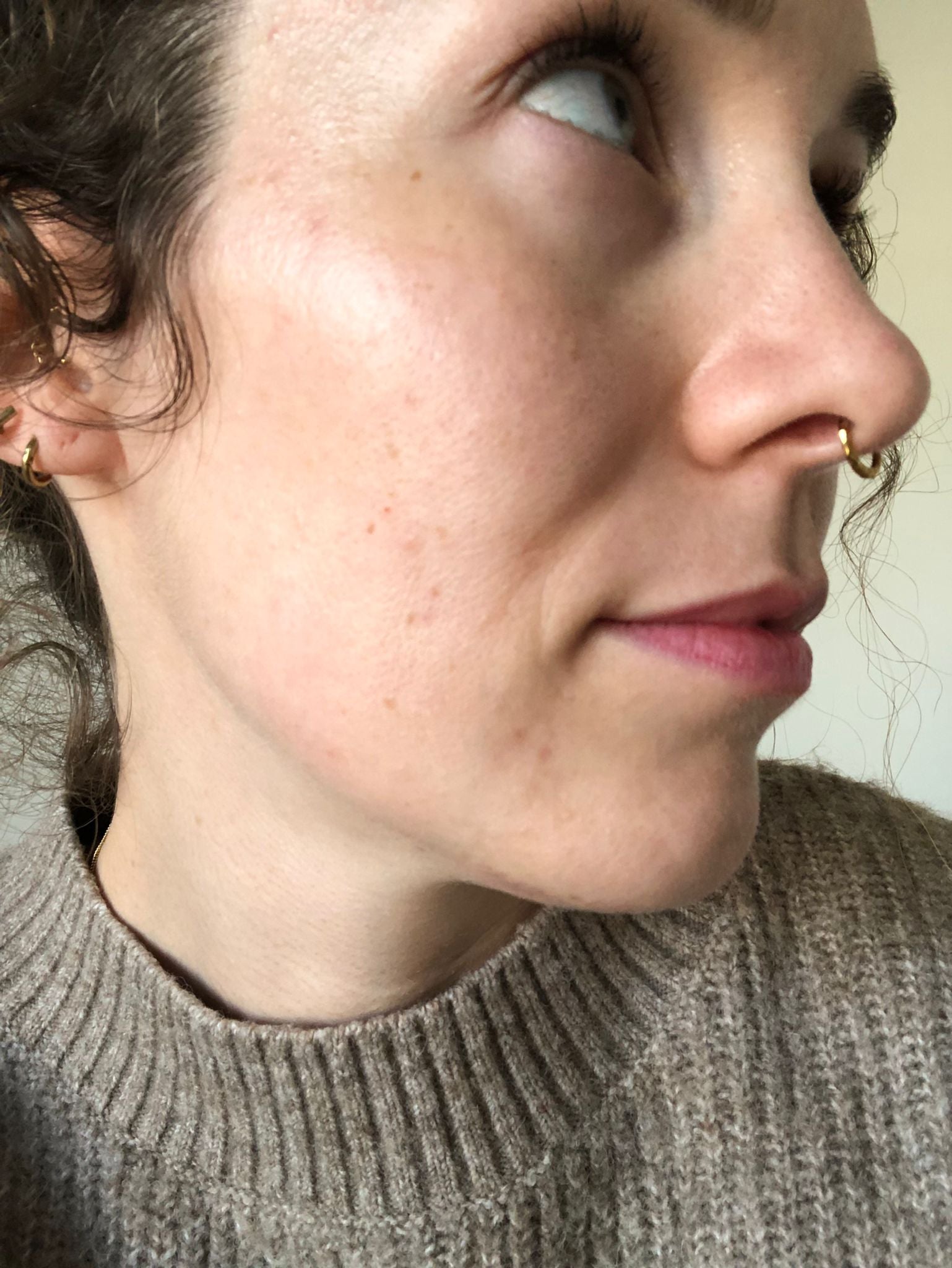 Voor_na-skincare-problems-pimples-Sil-na-1