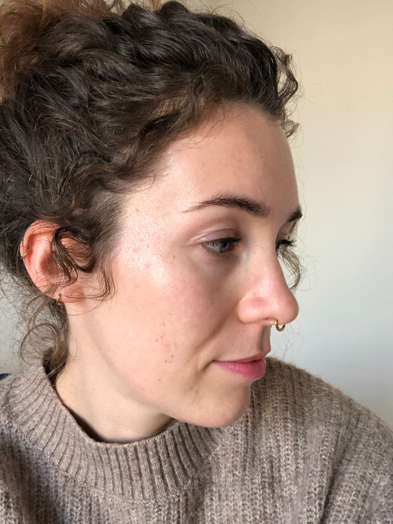Voor_na-skincare-problems-pimples-Sil-na-2