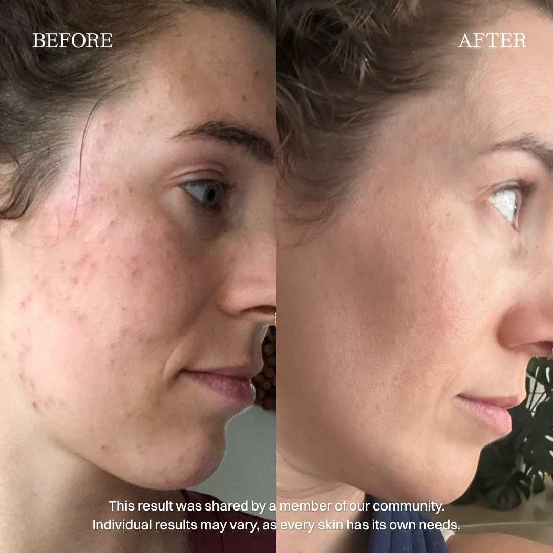nourist-voor_en_na-beyond_blemishes_serum-2