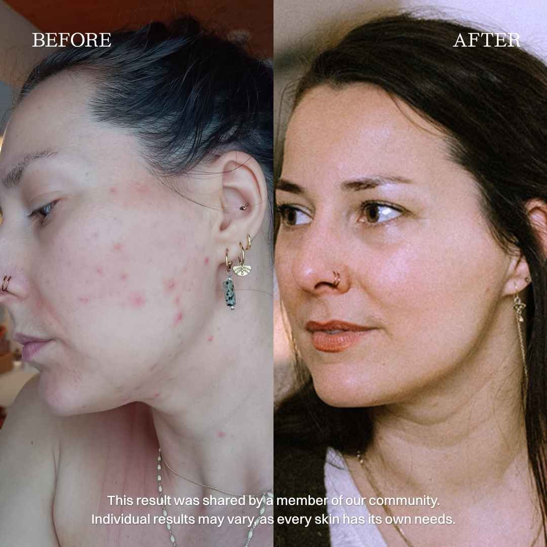 nourist-voor_en_na-beyond_blemishes_serum-3