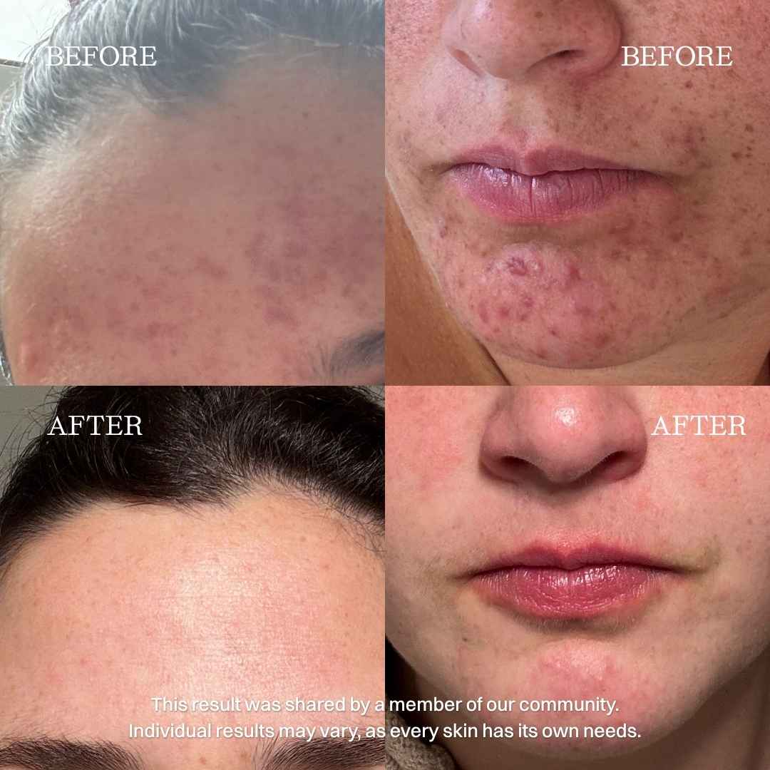 nourist-voor_en_na-moisturizer-2