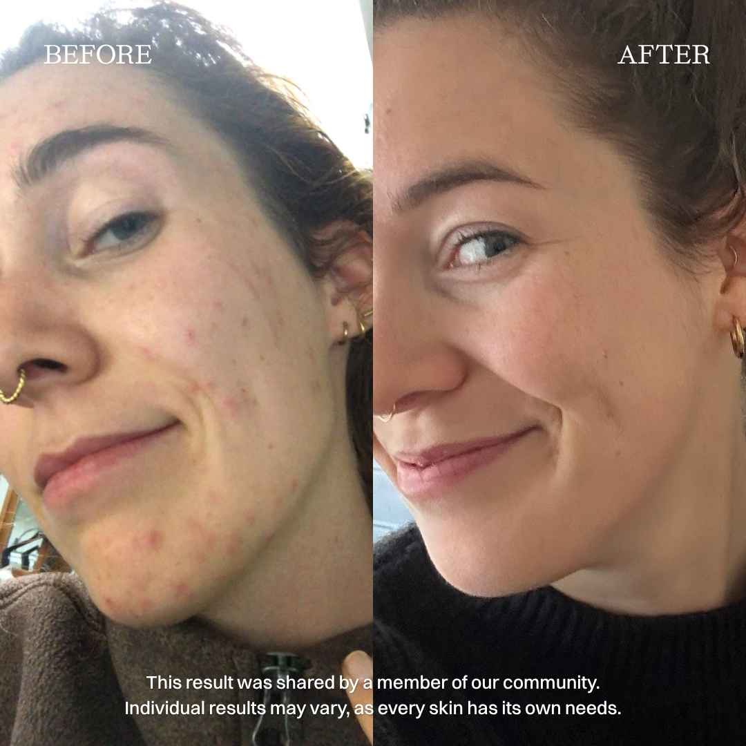 nourist-voor_en_na-skin_savior_serum