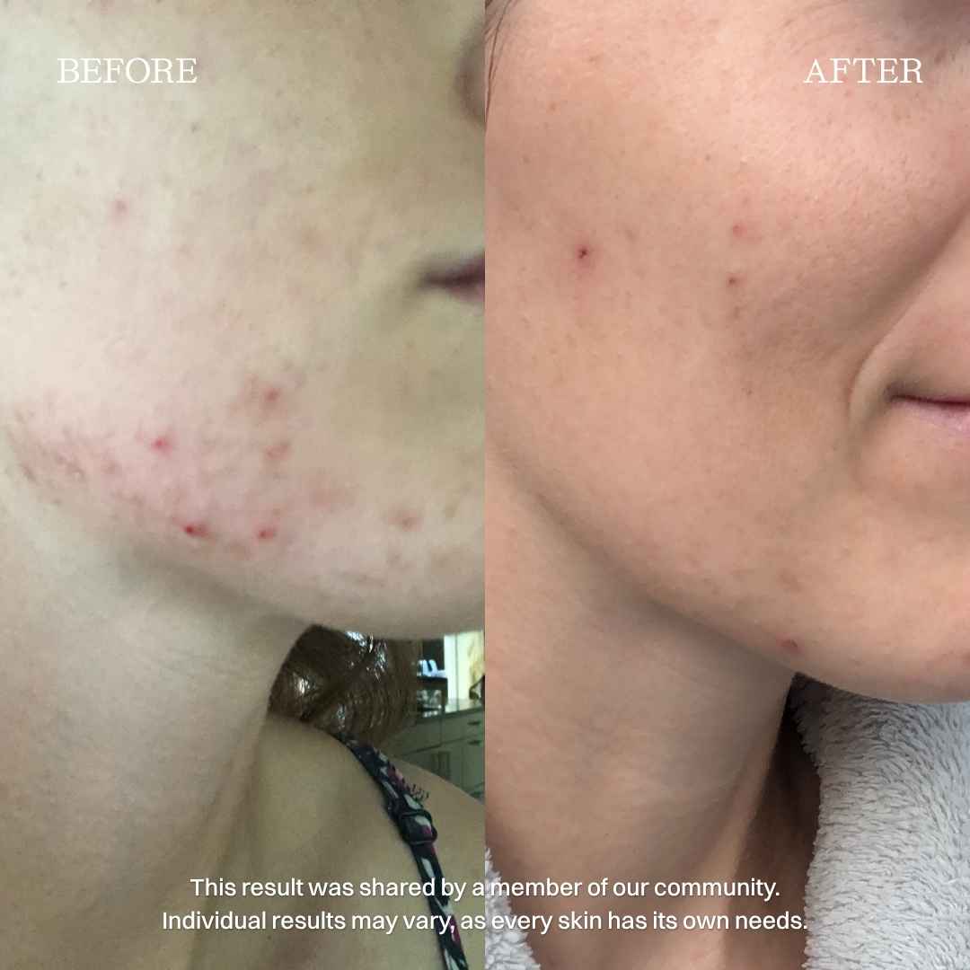 nourist-voor_en_na-stay_balanced_serum-1